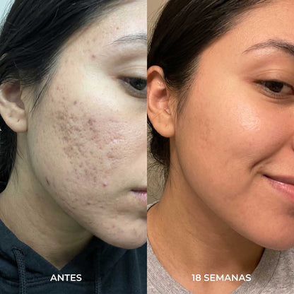 (SUPER 2X1) Stick Remodelador de Cicatrices de Acné™